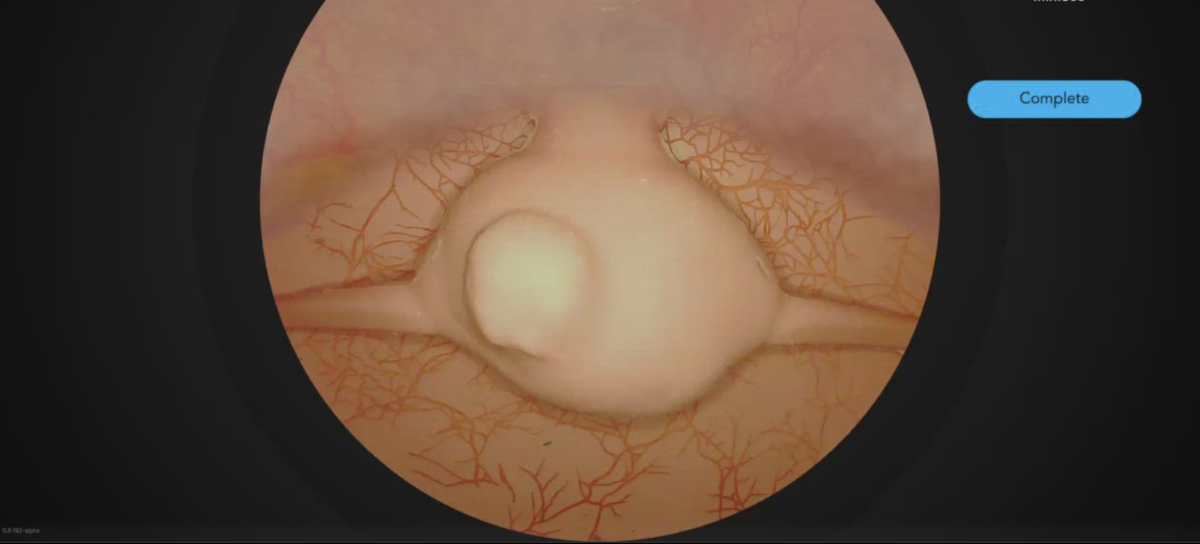 Myomectomy