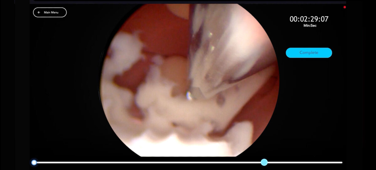 Header Hysteroscopic Fibroid Removal