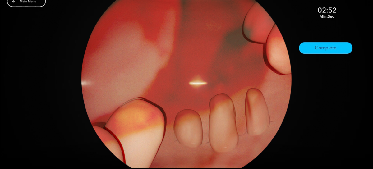 Hysteroscopic Polypectomy